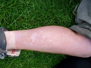 Tim's Sunburn, 2011 Photo by Jonathan Davey